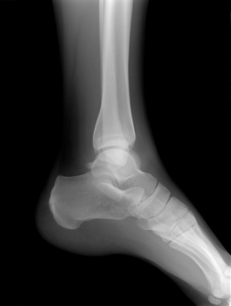 Xray of foot and lower leg - What are sprains and strains blog post